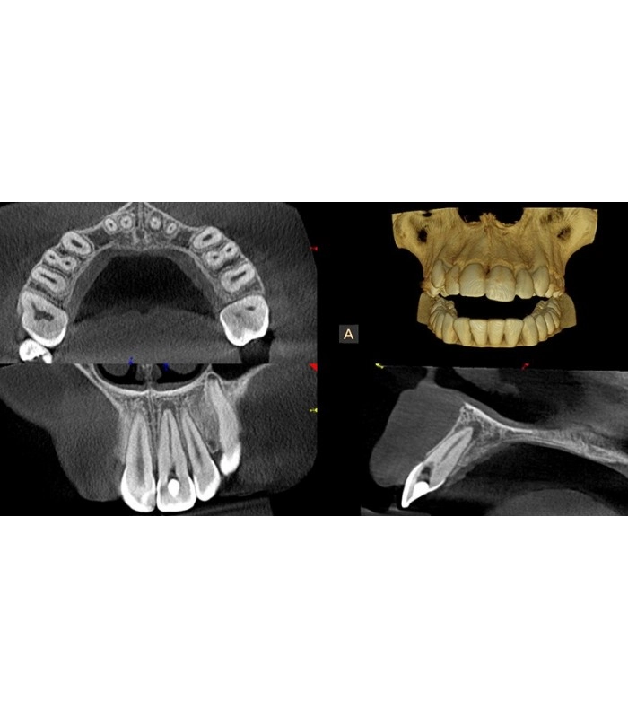 سی تی اسکن دندان کداک CBCT Carestream CS8100 EVO 3D