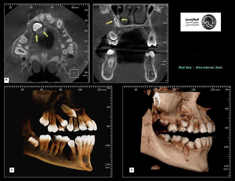 سی تی اسکن دندان کداک CBCT Carestream CS9300