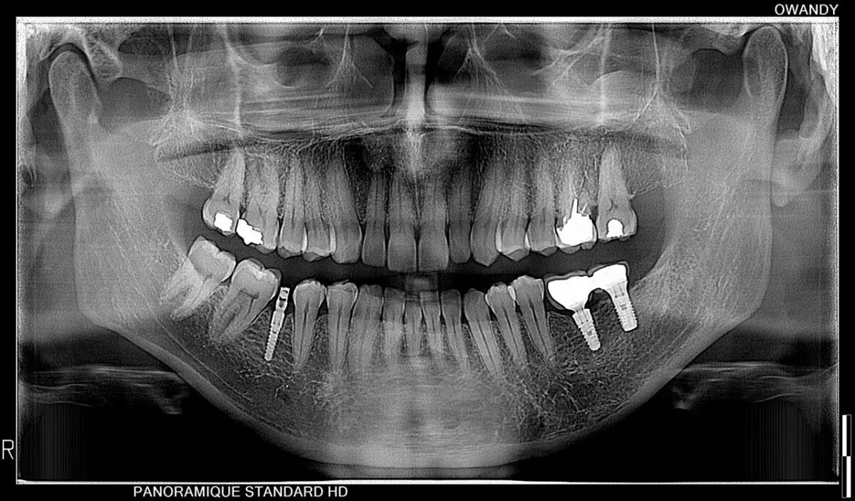 رادیوگرافی OPG و CBCT اوندی OWANDY