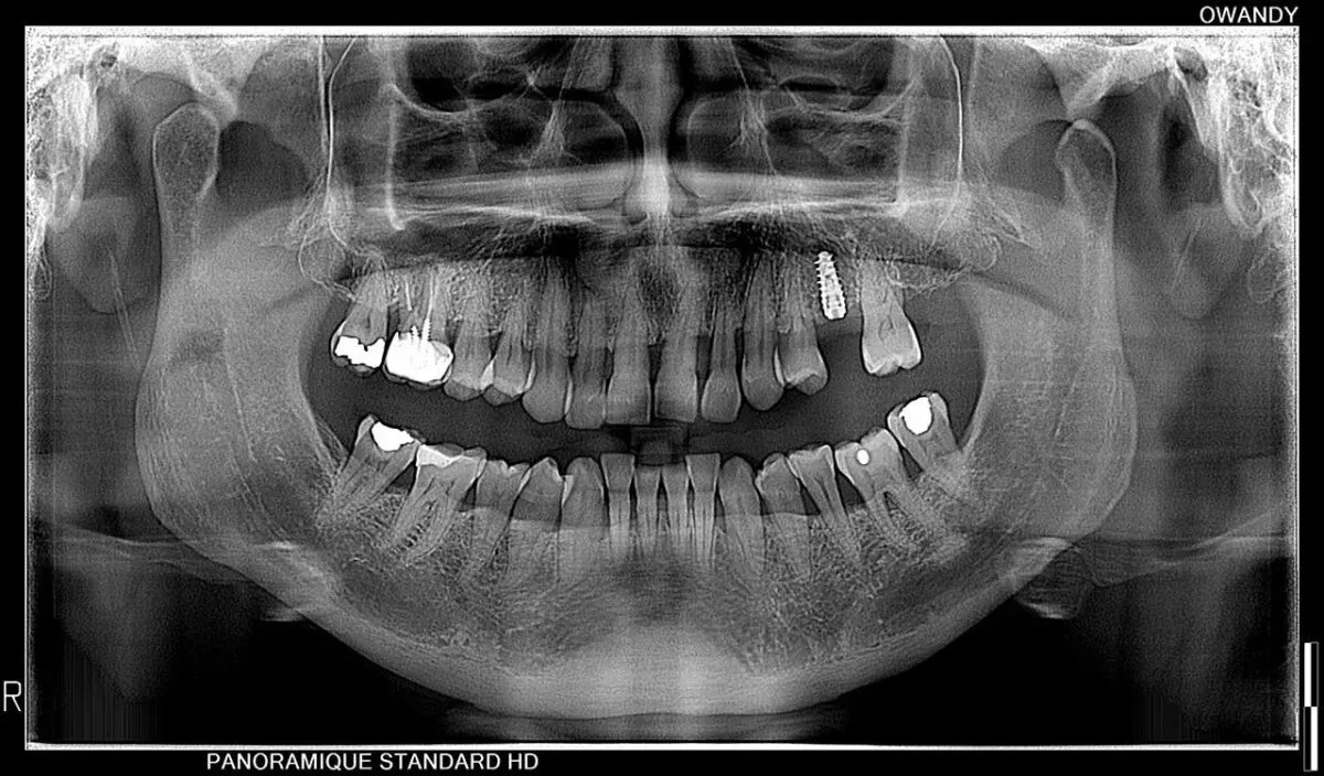 رادیوگرافی OPG و CBCT اوندی OWANDY