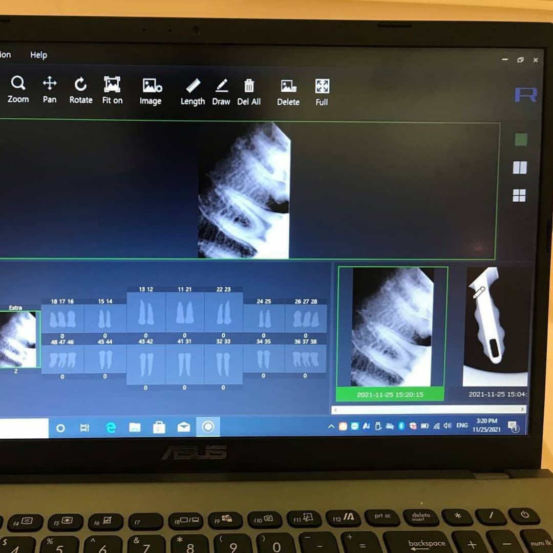 سنسور RVG رمدی Remedi