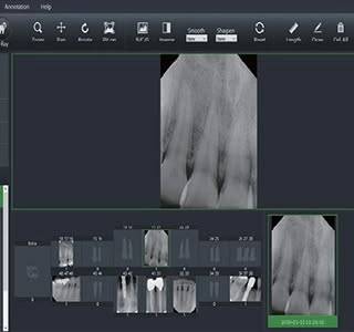 سنسور RVG رمدی REMEDI