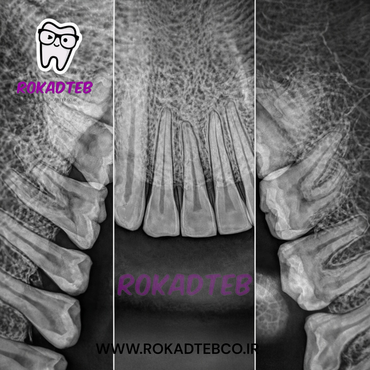 سنسور RVG کیفیت سنسور RVG سایز 1/5 Woodpecker وودپکر مدل i-Sensor 1/5 Woodpecker وودپکر مدل i-Sensor