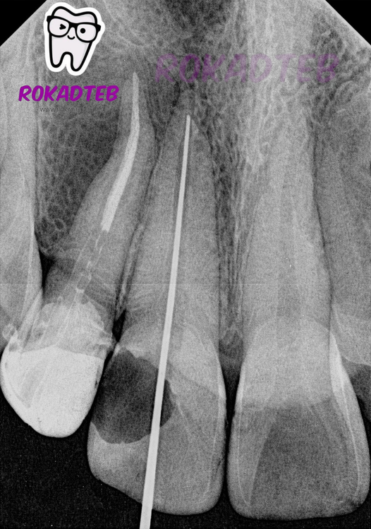 کیفیت تصویر سنسور RVG ایتیس Eighteeth مدل Nanopix | رکادطب