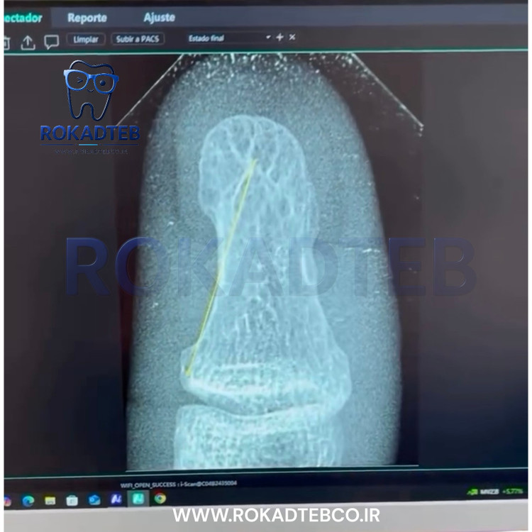سنسور RVG وودپیکر مدل isensor رکادطب